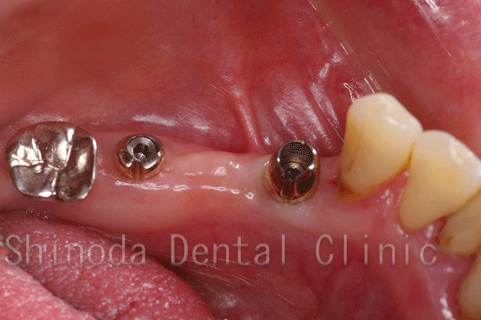 インプラント　臼歯　アバットメント