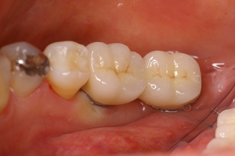 インプラント　大臼歯　セラミック　クラウン　2