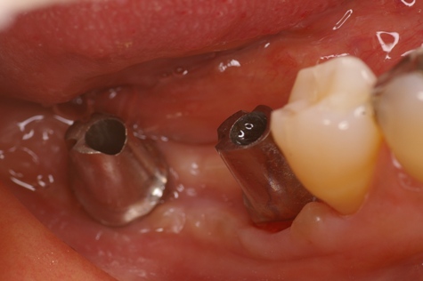 インプラント　大臼歯　アバットメント