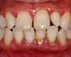 歯周病とインプラント