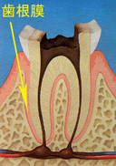 神経のない歯が痛いのはなぜでしょうか？