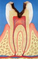 C3：歯髄（神経）に達する虫歯