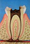 C4：歯髄（神経）に達する虫歯→歯髄が壊死