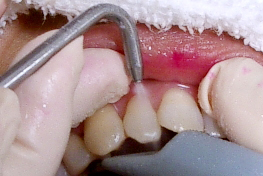 歯石・着色のクリーニング1