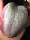 口臭発生の原因となる舌苔（ぜったい）