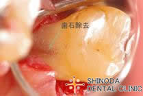 歯周外科2