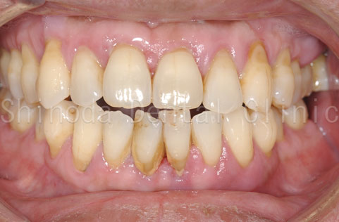 periodontitis01.jpg