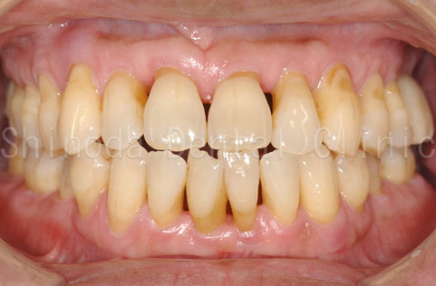 periodontitis02.jpg